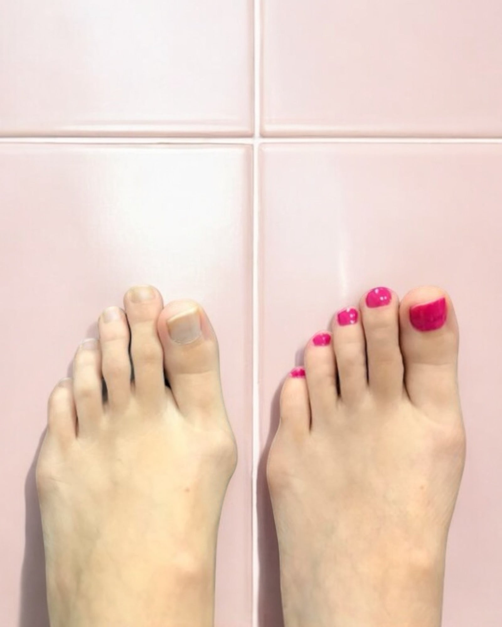 The After Party Silicon Gel Toe Separators & Foot Relief Alignment Socks - Value Bundle